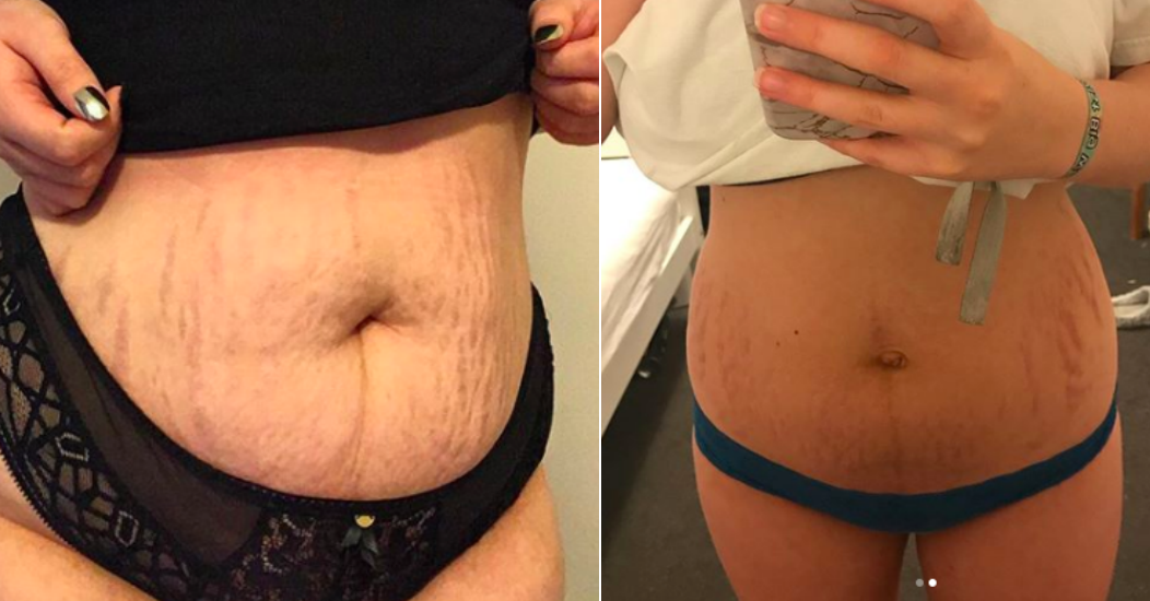 Women Are Posting Pics Of Their Stretch Marks On Instagram And Sharing Some...