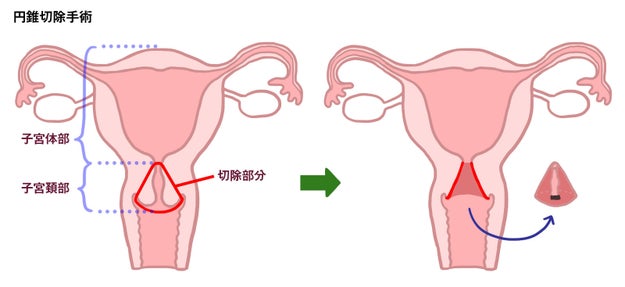 子宮頸がんで子宮を全摘した理系女子が伝えたいこと