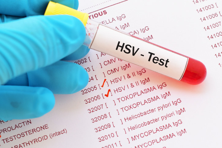 genital herpes test