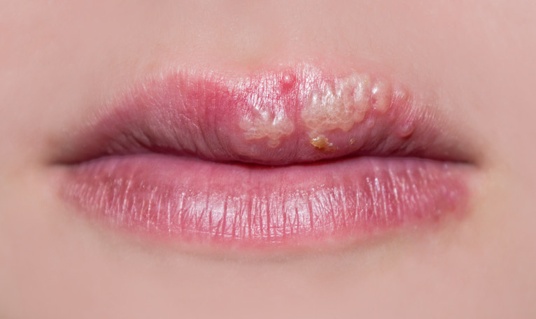 Here S What You Need To Know About Cold Sores And Herpes