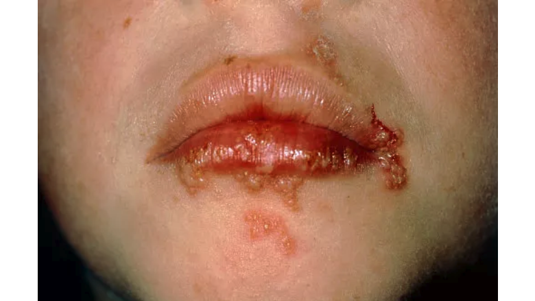 can you get cold sores from sharing a cigarette Here's What You Need To Know About Cold Sores And Herpes