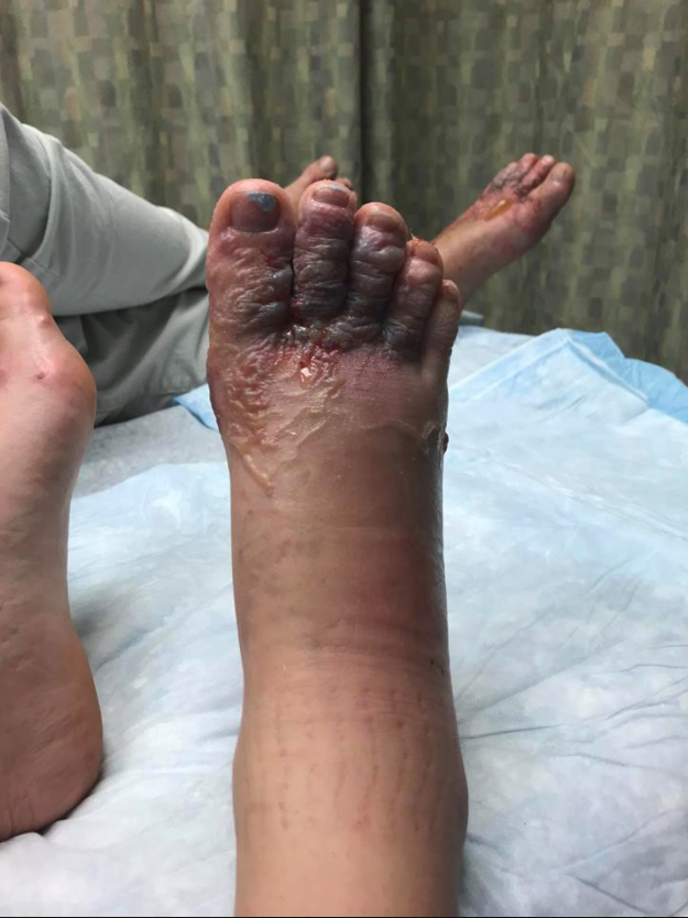 Couple Infected With Parasitic Hookworms At Beach Share Horrifying Photos