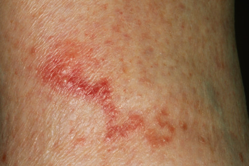 Roundworm Rash In Humans