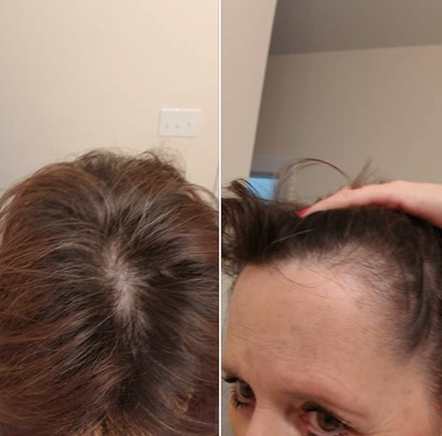 Harrington told BuzzFeed News she bought her first Monat products from her neighbor last year, and said she was so “impressed” she spent about $900 on the kit to become an MP. But soon, she said her hair started to fall out.