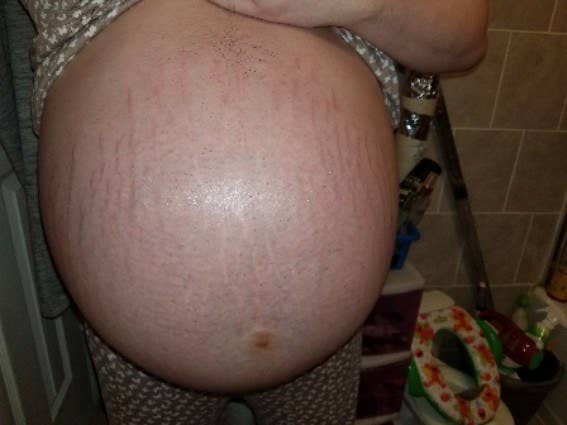 29 Things People Want You To Know About Their Stretch Marks
