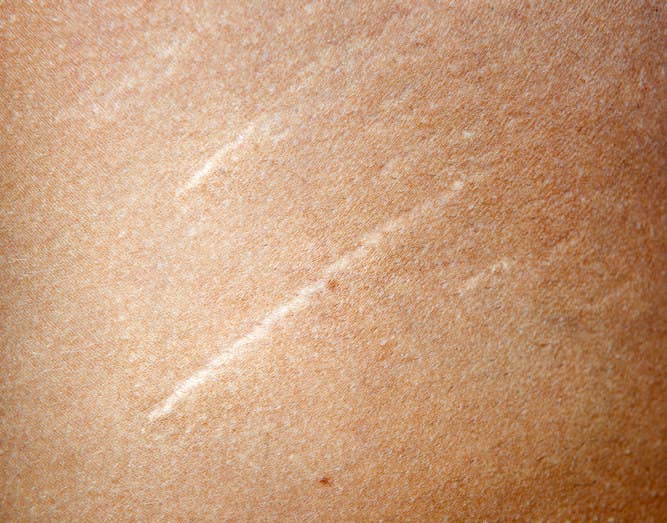 29 Things People Want You To Know About Their Stretch Marks