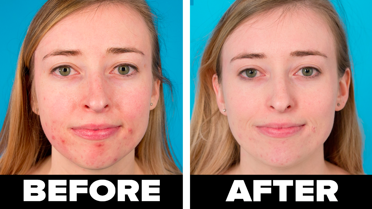 A before and after where the before shows red, inflamed cystic acne and the after shows a clear complexion