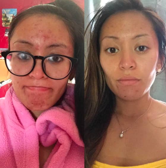 27 Skincare Products With Before And After Photos That Ll Blow Your Damn Mind