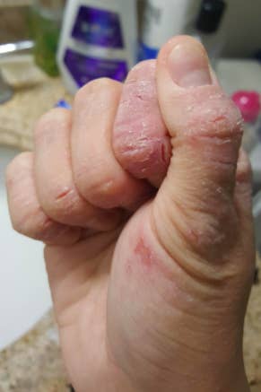reviewer's hand with deep dry cracks and cuts on fingers