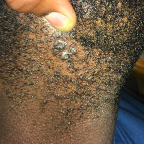 reviewer with large razor bumps on back of their head