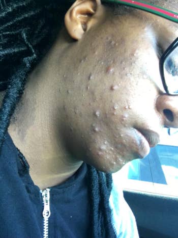 reviewer with lots of pimples on their cheek and chin