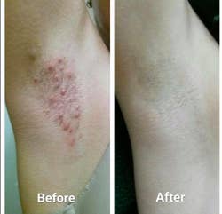 a before and after of a reviewer's underarm with lots of red razor bumps and then totally smooth