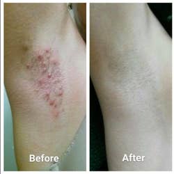 a before and after of a reviewer's underarm with lots of red razor bumps and then totally smooth