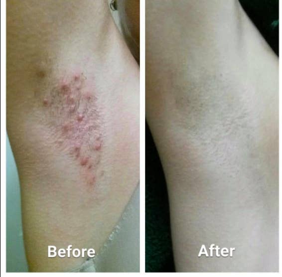 a before and after of an underarm with lots of red razor bumps and then totally smooth