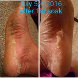 photos dated july 5, 6 after 1st soak, with skin starting to peel