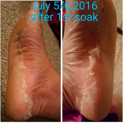 photos dated july 5, 6 after 1st soak, with skin starting to peel