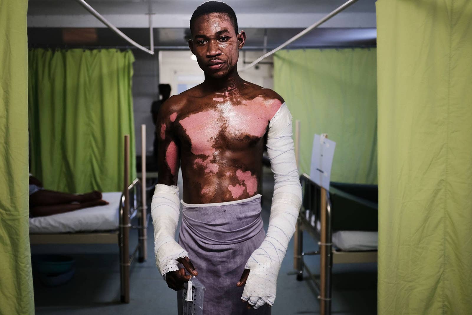 Shnider Avril, who was severely burned by an explosion from a propane tank is treated in the Doctors Without Borders (MSF) Drouillard hospital for burn patients on Feb. 12, in Port-au-Prince, Haiti. The hospital has the first dedicated burn unit in Haiti.