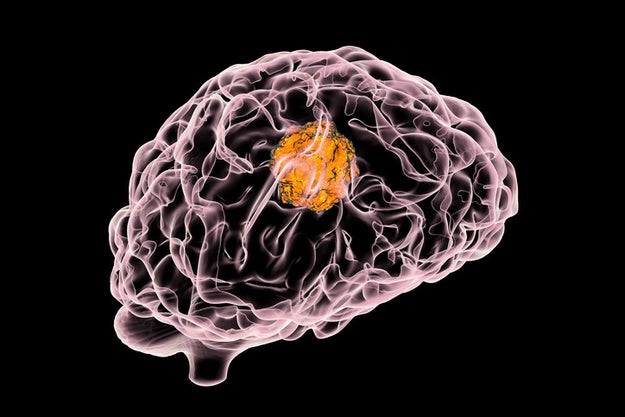 In 1984, a woman in England claimed that hallucinatory voices told her she had a brain tumor. The woman, who had no previous illnesses, was treated for hallucinatory psychosis. She continued to hear the voices that insisted she needed a brain scan. According to the British Medical Journal, the voices allegedly told her the exact location of her tumor. Her request for a scan was granted, and a tumor was found exactly where the voices had told her it would be.