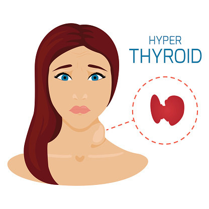 Some people have more severe symptoms, like eye protrusion and neck swelling.