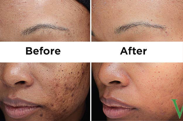 Dr. Henry says VI Peels usually ranges from $300 to 600, depending on the geography of the practice and if any peel-strengthening boosters are added. The above photo is from Dr. Henry's practice, Laser & Skin Surgery Center of New York.