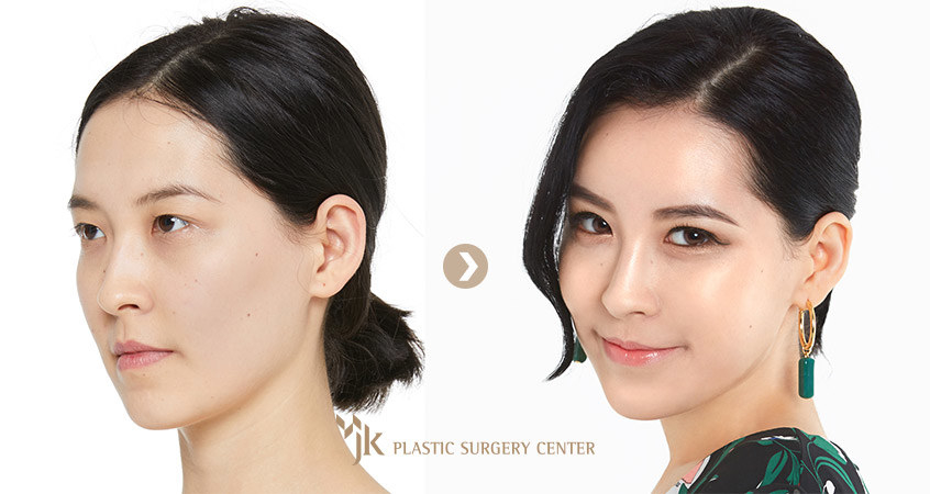 asian women plastic surgery