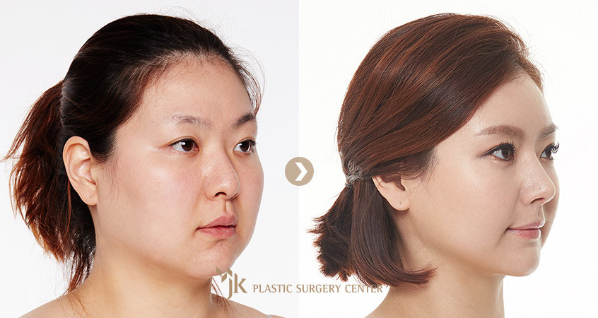 asian face surgery