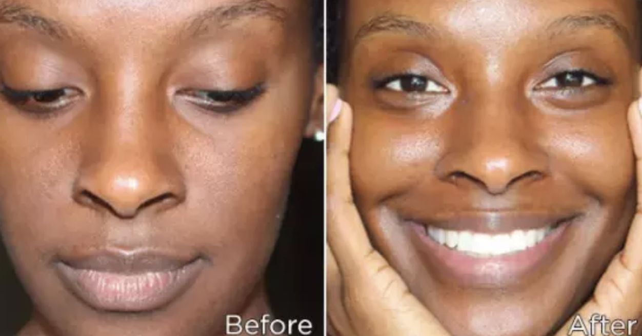 face slimming mask before and after 0 2