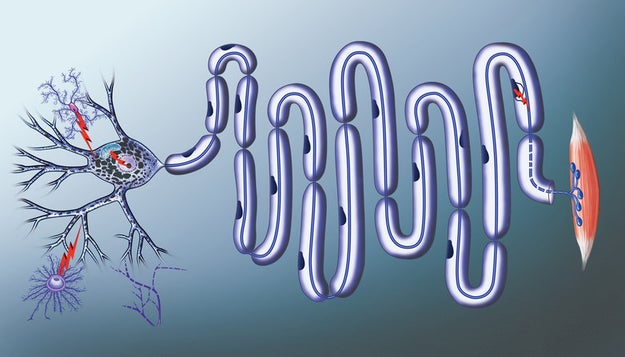 ALS eventually leads to paralysis and death. Every case is individual, but patients typically survive for three to five years after being diagnosed.