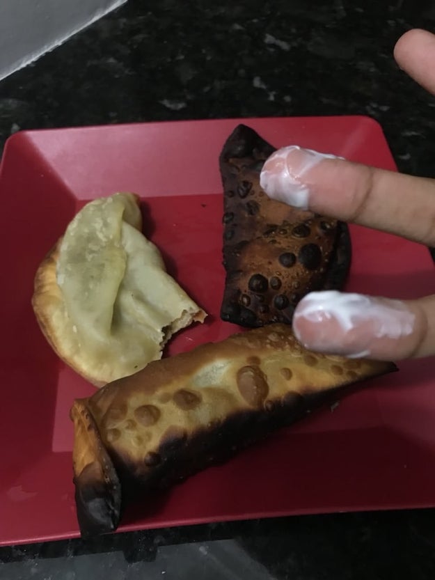 These dumplings are so burned that this person had to put burn ointment on their fingers!!