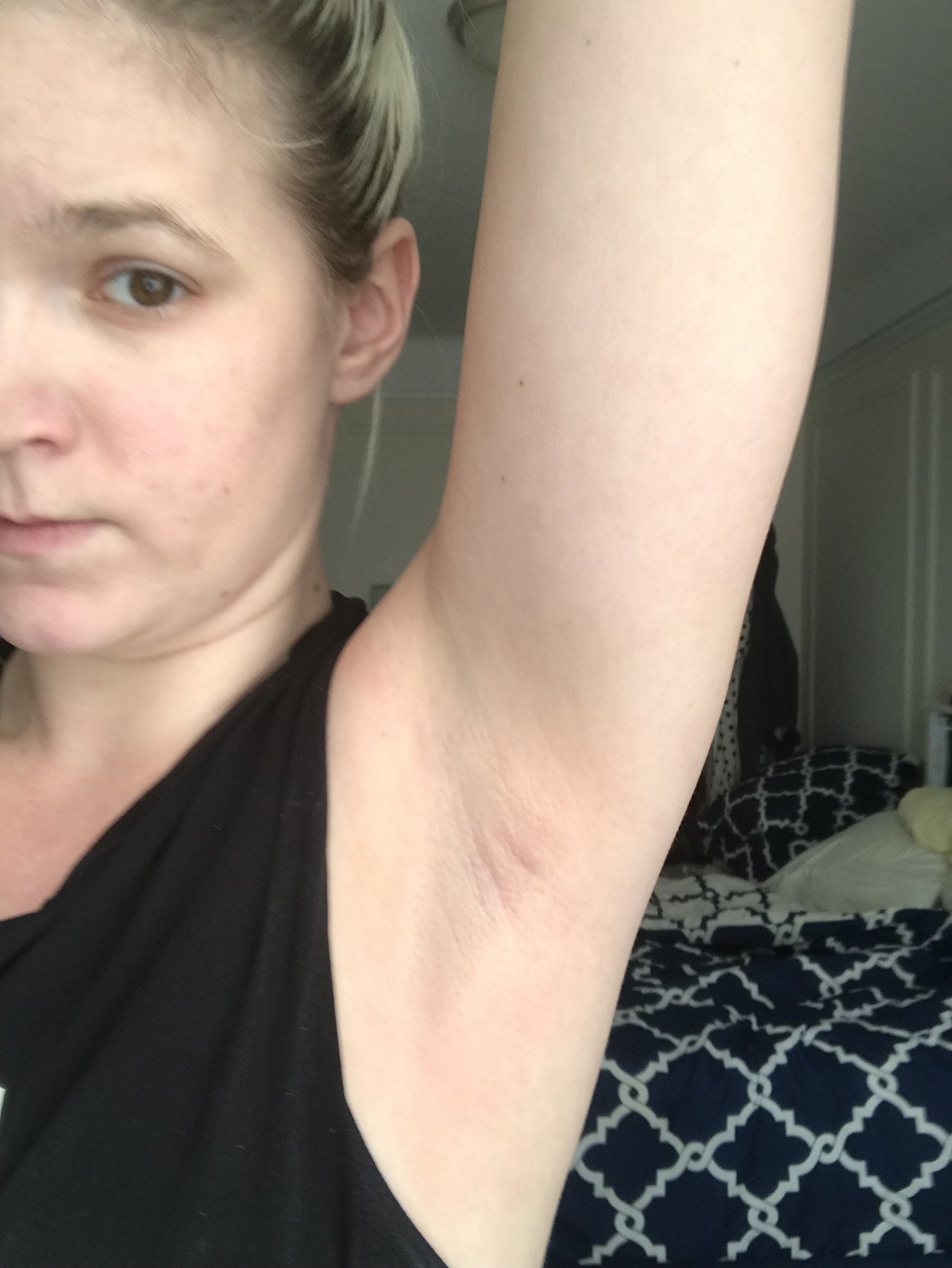 swollen lymph nodes in armpit