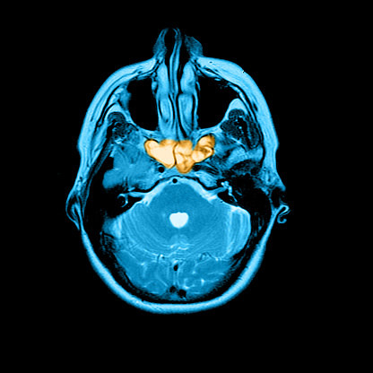 It is very rare for a sinus infection to spread to the brain, but antibiotics can usually help prevent these complications. If you are worried about sinusitis, see a doctor.