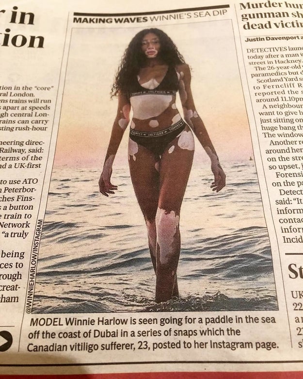 After seeing London newspaper The Evening Standard refer to her as a "Canadian vitiligo sufferer," Harlow took to Instagram to make it clear she has no time for publications that victimize her writing, "I’m not a 'Vitiligo Sufferer'. I’m not a 'Vitiligo model'. I am Winnie. I am a model. And i happen to have Vitiligo."