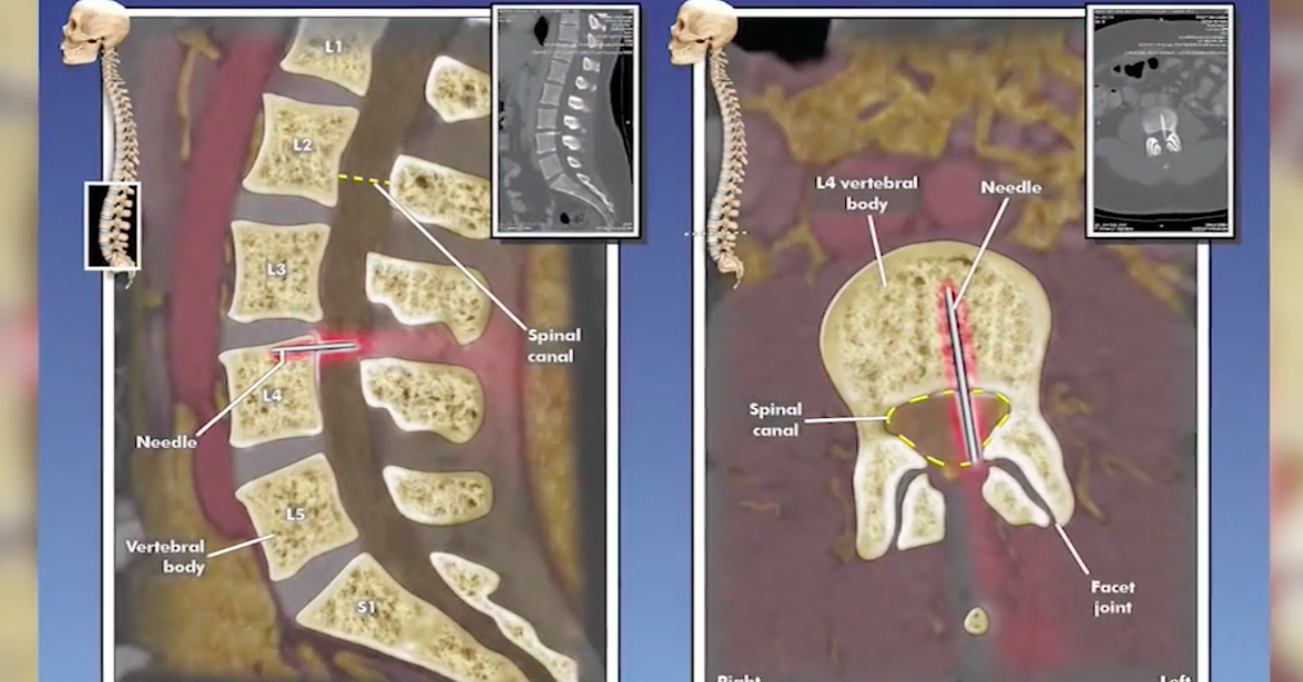 This Mom Discovered She Had A Needle In Her Spine 14 Years After Giving