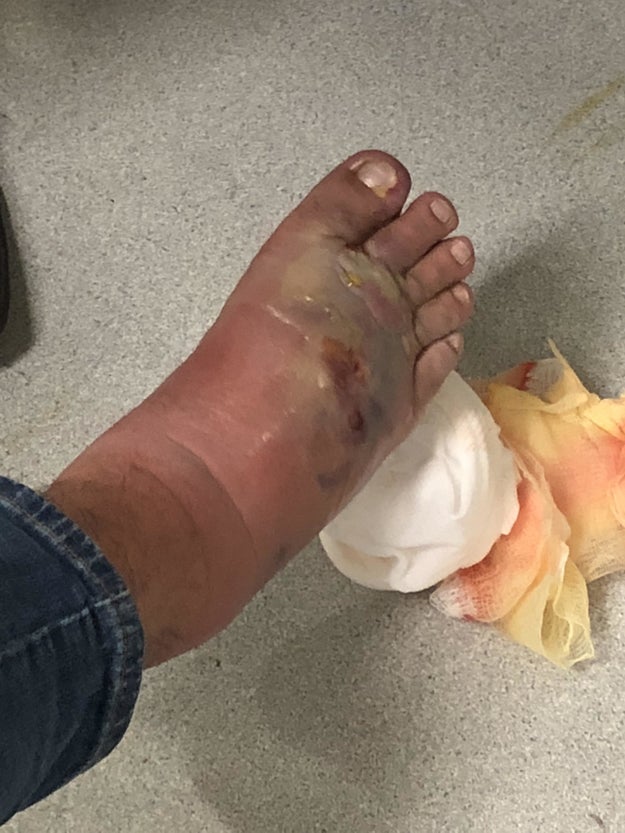 Three days after his foot first became swollen, Reyes noticed his sock was wet. When he took it off, he saw his foot was covered in yellowish blisters that were leaking pus and blood.