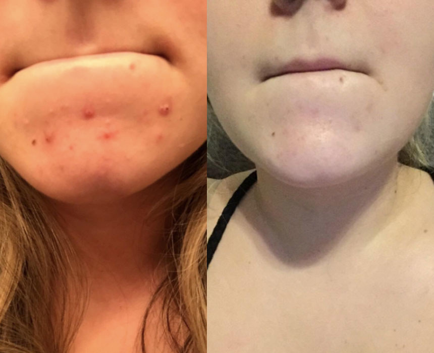 face slimming mask before and after you have