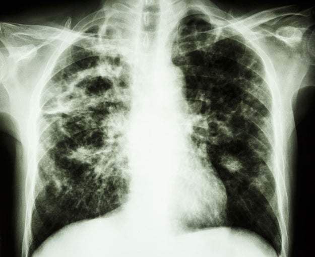 Between 2000 and 2015, eight dentists and one dental technician developed a lung condition called idiopathic pulmonary fibrosis, and seven of the patients died.