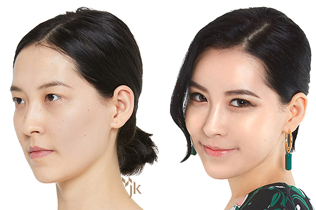 3 Best Clinics for a Nose Job in Korea