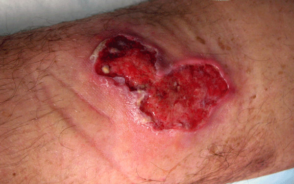 The ulcer typically starts as a painless bump on the skin. If left untreated, it can eventually destroy soft tissue and cause permanent disfiguration or disability.