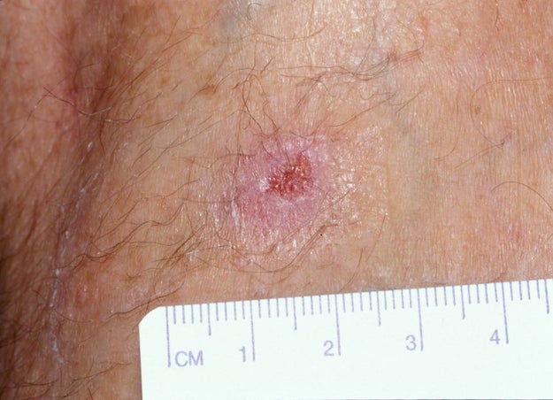 Cases of Buruli ulcer were once considered rare in Australia, but now they're happening at epidemic levels.