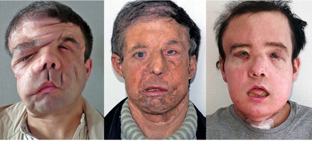 Jérôme Hamon, a 43-year-old from France, has become the first person in the world to successfully receive two face transplants.