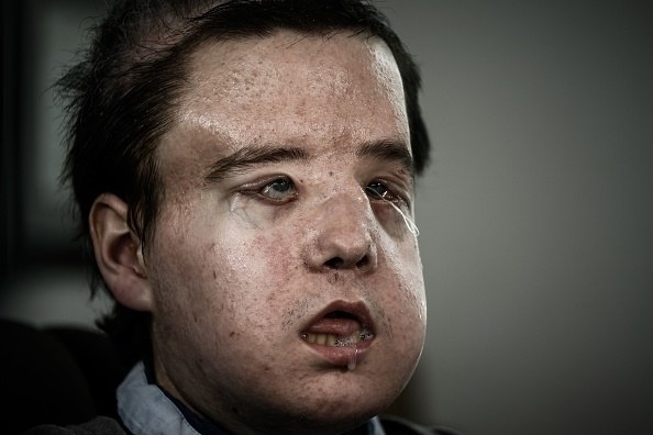 Hamon's transplant is described as "exciting" and "very encouraging" for the future of face transplants.