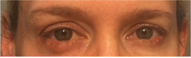 A group of unhappy Rodan + Fields customers have filed a class-action lawsuit against the company, saying its "lash boost" serum left them with swollen, red, and crusty eyes.