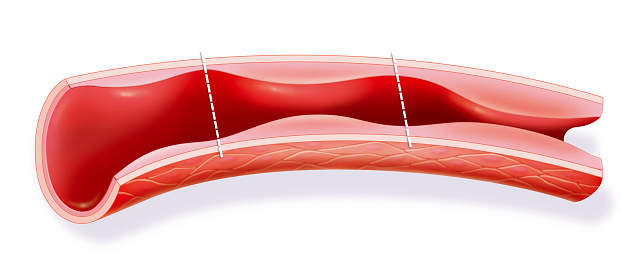 Consuming high levels of sodium over time can increase the risk of high blood pressure, particularly in people who are sensitive to the effects of sodium. High blood pressure can lead to heart attacks and strokes.