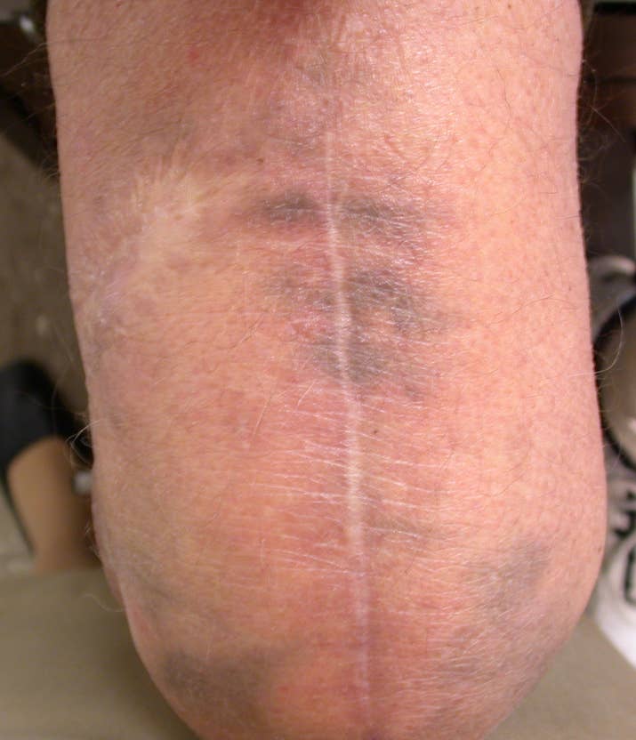 An example of a patient (not the patient in the case report) with minocycline-related pigmentation.
