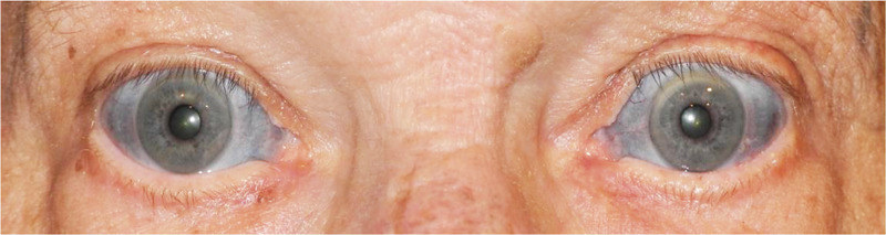 A Man's Eyes Were Stained Blue After He Took An Antibiotic To Treat  Inflammation