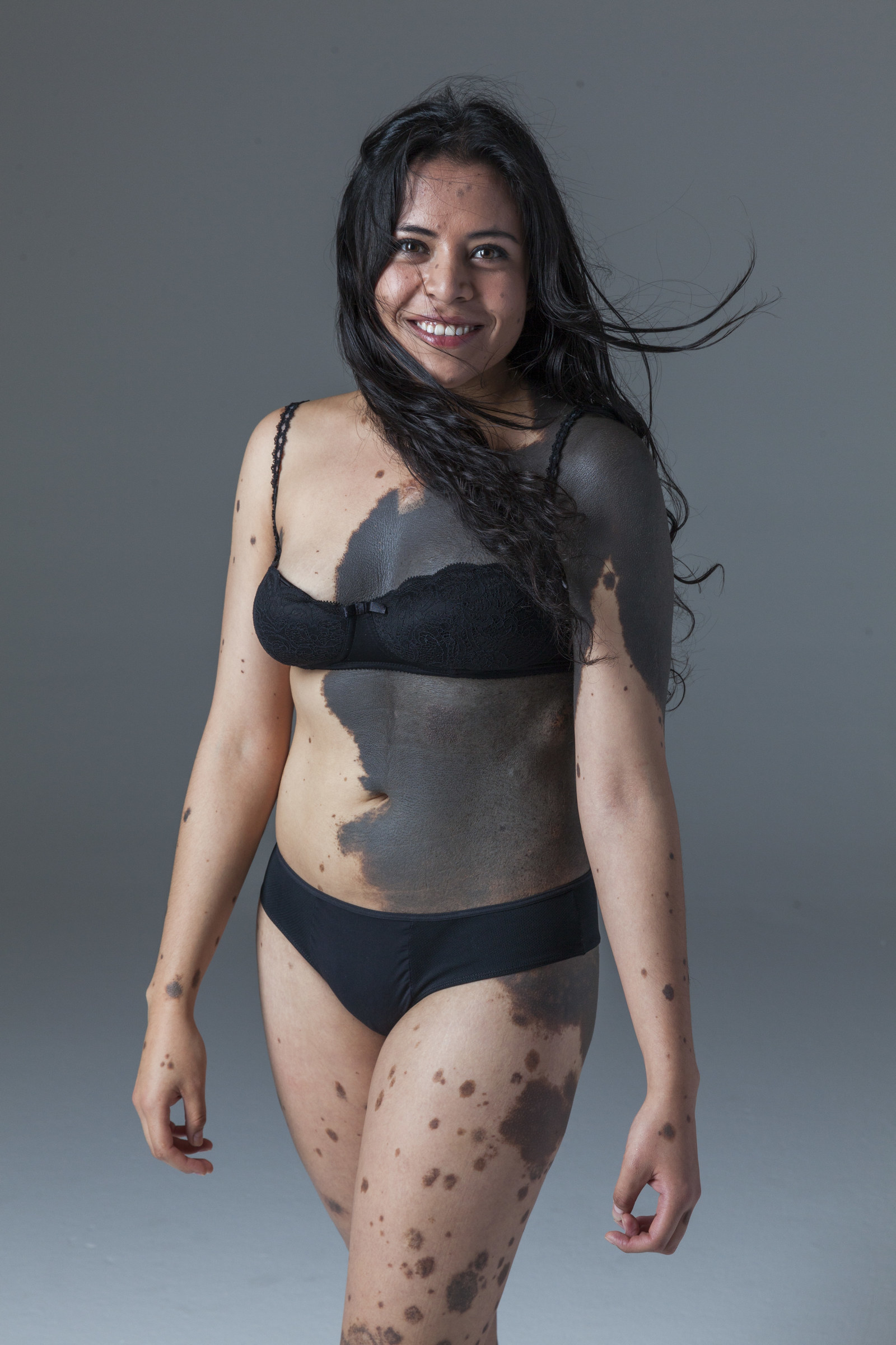 this-woman-is-embracing-her-birthmarks-in-the-most-beautiful-way