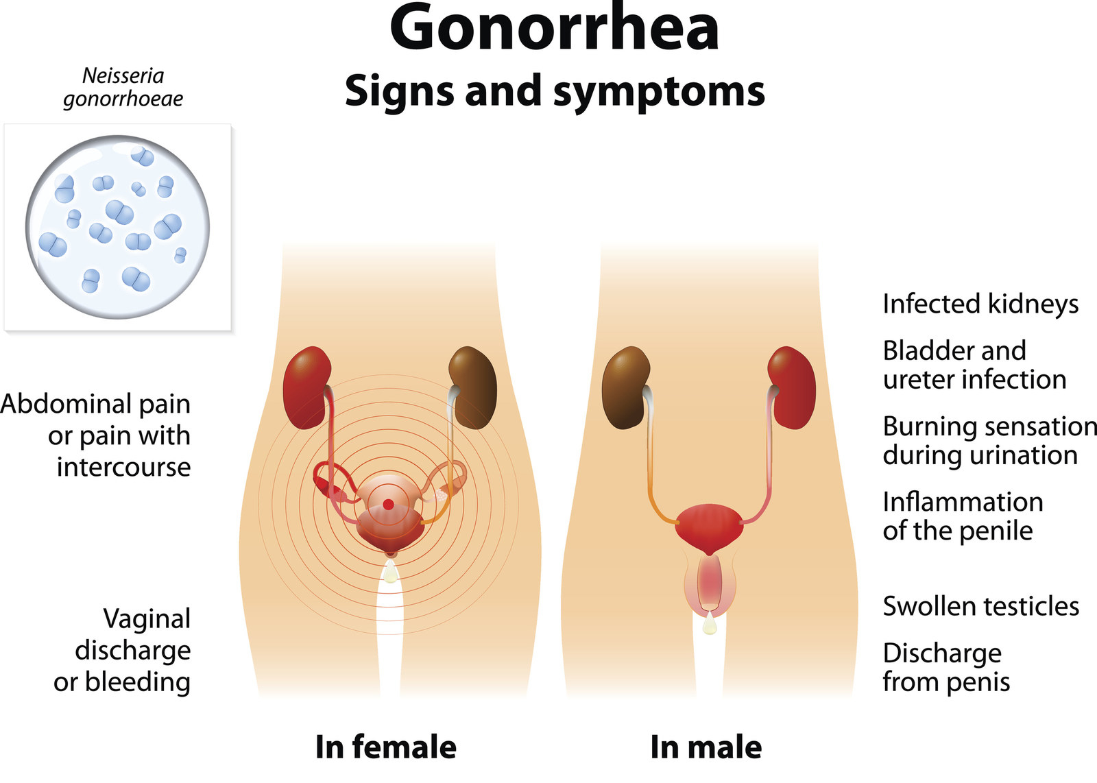 super gonorrhea symptoms male