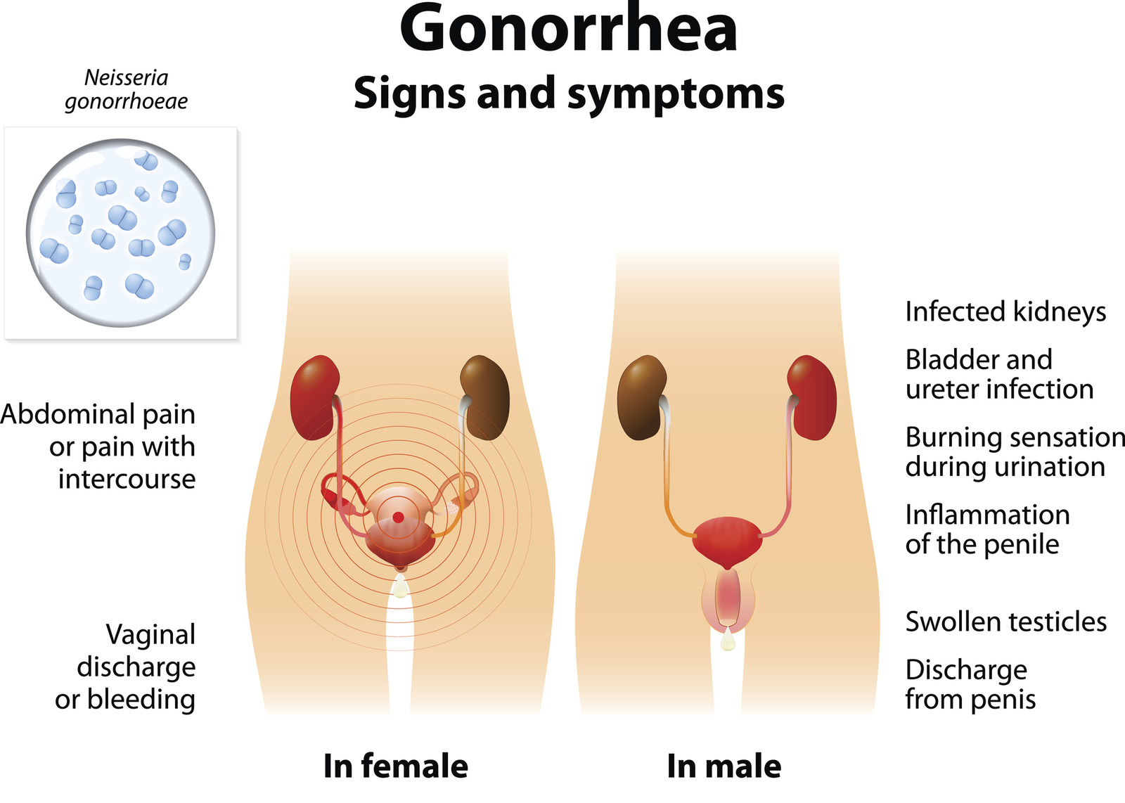 mens gonorrhea symptoms