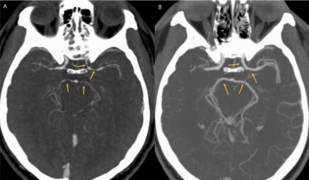 At the ER, a CT scan of the man's brain showed that his arteries were narrowed, which is known as reversible cerebral vasoconstriction syndrome (RCVS).