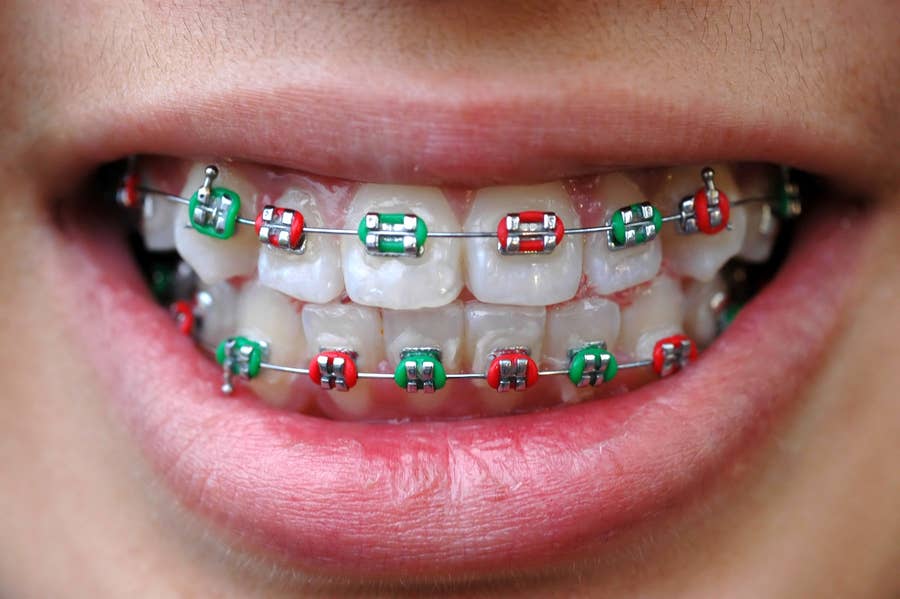 18 Photos That Only People Who Had Braces Will Understand One has perference for what he likes, for color selection, choose one that please you most since braces color do not fuction on your smile. only people who had braces will understand